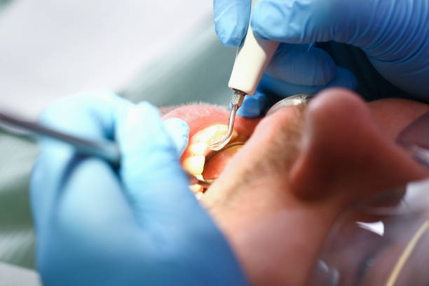Best Emergency Tooth Extraction in Central City, IL